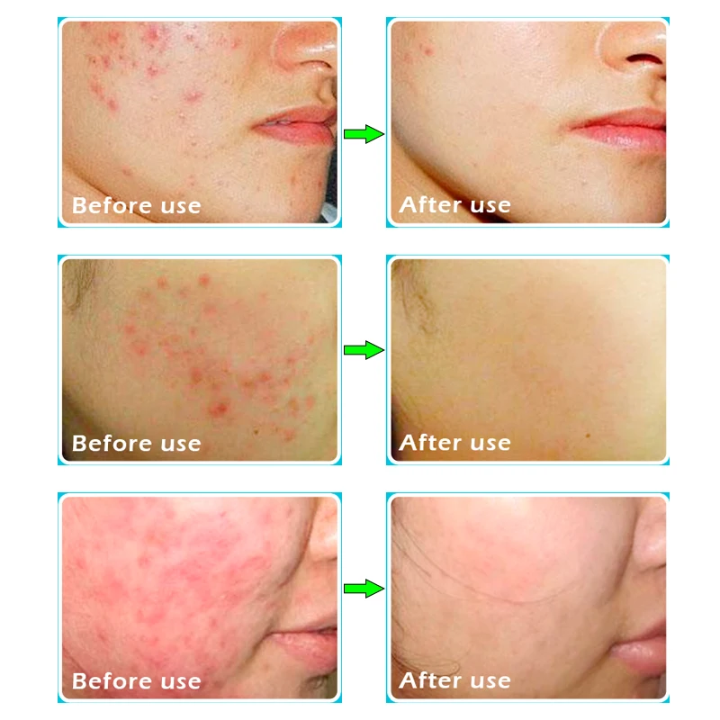 Acne Behandling Whitening Cream Anti Acne Acne Ar Fjernelse Hudorme Formindske Porer Facial Oil-Control Skønhed Huden Pleje sæt